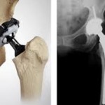 Prótesis de cadera: recomendaciones y tratamiento de fisioterapia